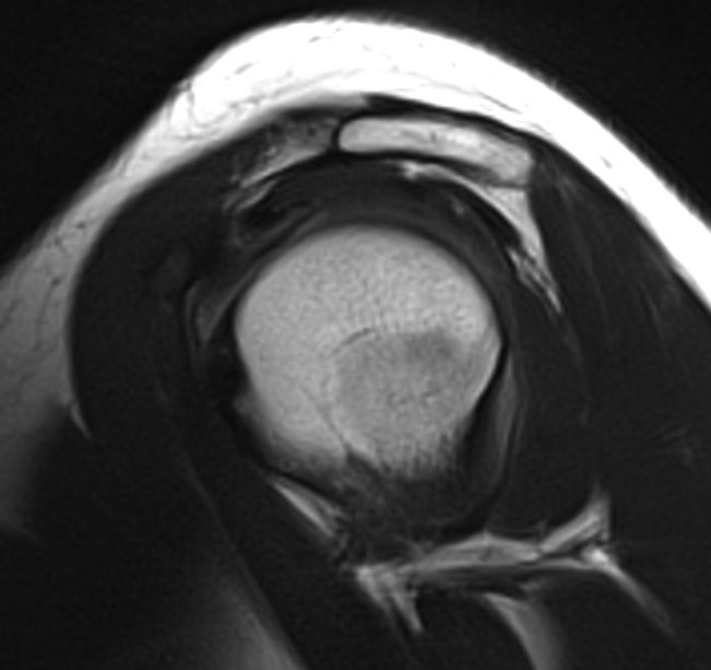 Axillary Nerve Sagittal MRI 2